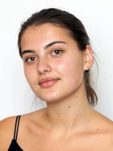 lip filler - example after